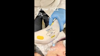 Stellar M22 IPL Treatment | Acne Treatment