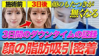 【整形】顔の脂肪吸引3日間のダウンタイムに密着【1day小顔脂肪吸引】