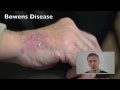 Dr Ashworth Bowens Disease