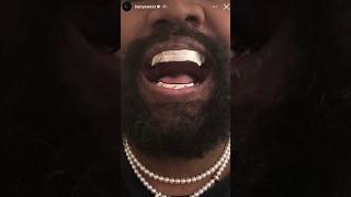 Kanye West s’est-il fait arracher les dents pour des grillz ?