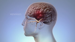 Inside a Migraine: The Body's Response to an Attack | WebMD
