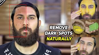 6 WAYS TO REMOVE DARK SPOTS | Black Spots, Hyper Pigmentation \u0026 Acne Scars | Home Remedies