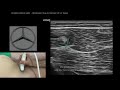 proximal hamstrings ultrasound landmarks smug 2 mins series