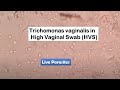 Live Trichomans vaginalis in HVS  saline wet mount