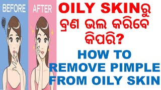 ୫OILY SKINରୁ ବ୍ରଣ ଭଲ କରିବାର ଉପାୟ,ODIA,ODIA HOME REMEDIES,5SIMPLE STEPS  REMOVE PIMPLE FROM OILY SKIN