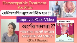 Haemorrhoids/Piles /অর্শের হোমিওপ্যাথিক চিকিৎসা/ একটি ইমপ্রুভড কেস ভিডিও/ Improved Case Video