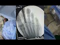 CLOSED REDUCTION AND K WIRE FIXATION FOR TOE FRACTURE