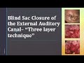 Blind Sac Closure of the External Auditory Canal -”Three layer technique”