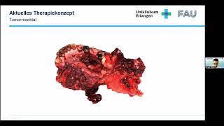 DZI-Webinar „Immuntherapie von Kopf-Hals-Tumoren - ist die Chirurgie bald überflüssig?\