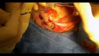 Calvarial Outer Table Resection