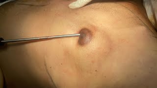 Gynecomastia surgery Bangladesh | গাইনাকোম্যাস্টিয়া সার্জারি | Male boobs surgery | Dr Iqbal Ahmed