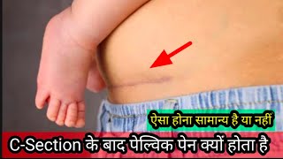 C-Section के बाद पेल्विक पेन क्यों होता है, ऐसा होना सामान्य है या नहीं |  pelvic pain relief Tips.