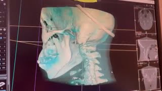 What is the Blair Upper Cervical Technique?
