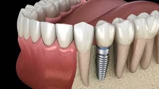 Implantes dientes premolares - CEOQ Quilmes