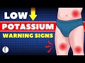 Signs of Low Potassium and Natural Treatment | Potassium Deficiency | Hypokalemia