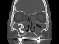 Endoscopic removal of unusual dental foreign bodies in the maxillary sinus