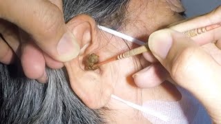 This Is One Massive Earwax Stuck And Removed from Woman's Ear