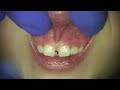 frenectomy labial dr. lawrence kotlow narrated