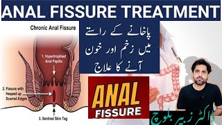 What is Anal fissure | Causes-Symptoms \u0026 Treatment| गुदा विदर और उसका उपचार | Urdu-Hindi | Foryou