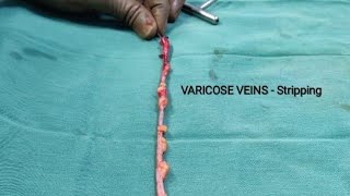 Varicose veins - Stripping - उपचार का विकल्प