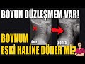 BOYUN DÜZLEŞMESİ İYİLEŞİR Mİ? #aktifizyo #boyunağrısı #kulunçağrısı #boyundüzleşmesi