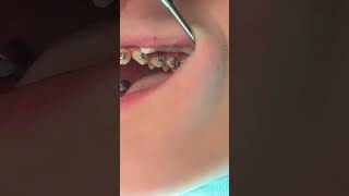 Bracket repositioning in orthodontics - Why they do it? Toohtime Family Dentistry New Braunfels tx