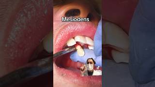 Get out Mesiodens! Extra tooth