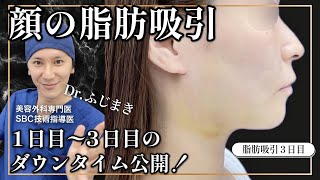 【ダウンタイム】圧迫数日〜顔の脂肪吸引を含む小顔治療、術後翌日〜３日目のダウンタイム中はどんな感じ？【解説：ふじまき先生、美容外科専門医、湘南美容クリニック東京秋葉原院】