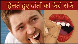 हिलते हुए दांतों को कैसे रोकें | Hilte Hue Daanton Ko Kaise Roken | Hilte Hue Daanton Ka Ilaaj