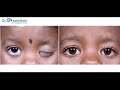 how successful is ptosis surgery explained by an eye plastic surgeon ptosis dr anamika joshi