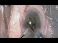 phaco in mid dilated pupil. dr naveen gopal 2