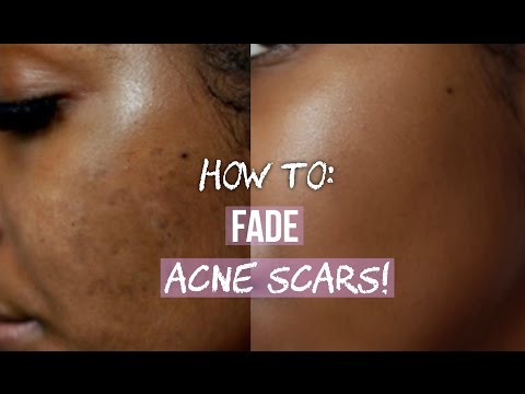 HOW TO GET RID OF ACNE SCARS ON FACE & BODY! HOW TO GET RID OF ACNE SCARS ON FACE & BODY!