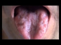 Tongue Fasciculations | NEJM