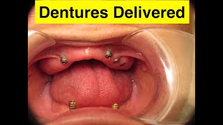 Implant Overdenture Delivered - All on 4