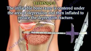 Tibial Plateau Fracture Balloon Osteoplasty - Everything You Need To Know - Dr. Nabil Ebraheim