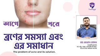 ব্রণের সমস্যা এবং এর সমাধান ।। The problem of acne and its solution.