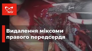 Міксома правого передсердя 🔷 Інститут серця