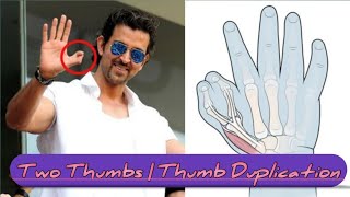 Two Thumbs on One Hand | Thumb Duplication |  Split Thumb | Bifid Thumb #facts @facts.fictions