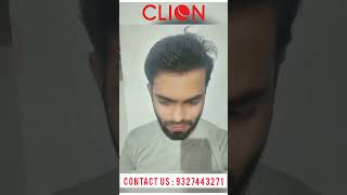 Hair transplant in ahmedabad Clion Clinic