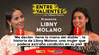 Libny Molano: Venció el bullying por sus más de 200 lunares gracias a su pasión por la música