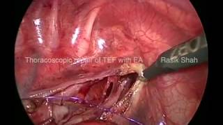Thoracoscopic Repair of Tracheo-esophageal Fistula with Esophageal Atresia by Rasik Shah