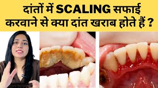 दांतो की सफाई करवाने से क्या दांत खराब होते है | Does Getting Your Teeth Cleaned Spoil Your Teeth?