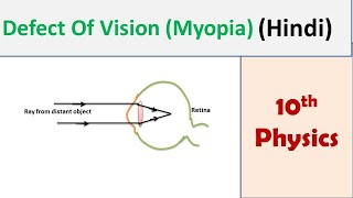 Defect Of Vision (Myopia) [Hindi]