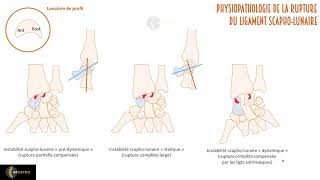 Tutoriel IMOSTEO #6 : physiopathologie et sémiologie radiologique de l'instabilité scapho-lunaire