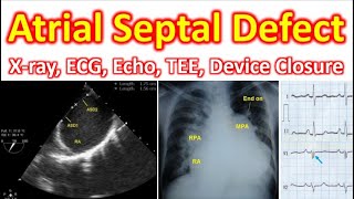 Atrial Septal Defect: X ray, ECG, Echo, TEE, Device Closure