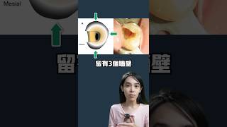 這種狀況下，抽神經的牙齒不用套假牙#根管治療#牙套