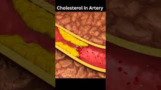 Cholesterol in Artery