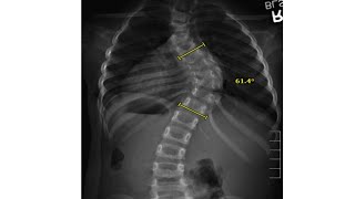 Expert Insight for Understanding Scoliosis in Children