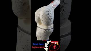 Total Knee Replacement Surgery 3D #shorts