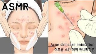 ASMR- Relaxing and Satisfying | Pimples |How to Remove Acne with ASMR | Blackheads | Step-by-Step